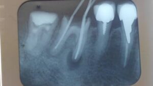 根管治療中のレントゲン画像