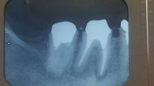 炎症の部分のレントゲン画像